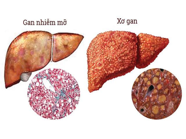 Cả triệu người mắc ung thư gan, gan nhiễm mỡ mà không biết đến những ”thần dược” này