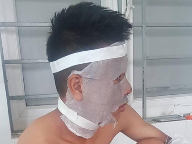 Nổ chùm bóng bay, 3 cầu thủ trẻ Sông Lam Nghệ An bị bỏng nặng