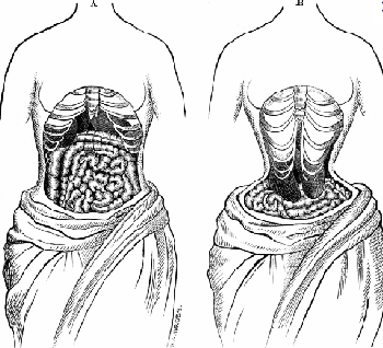 Phẫu thuật loại bỏ sương xườn trước (trái) và sau