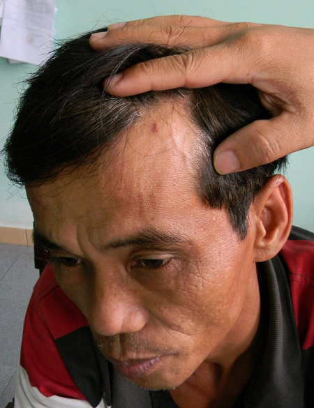  Anh Võ Văn Tâm, Trưởng Ban Bảo vệ dân phố phường Trường Xuân bị lái xe Diệp Anh Thảo quát tháo, đánh vào đầu làm trầy xước.