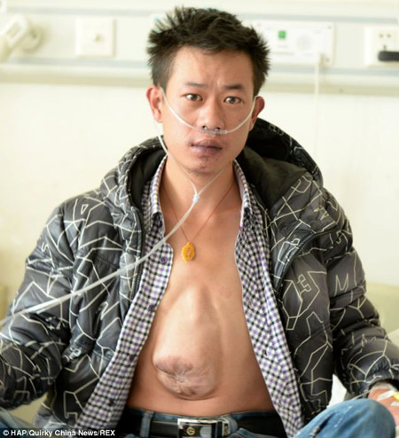 Chàng trai 24 tuổi Ho Zhiliang với trái tim nằm sai vị trí bẩm sinh.