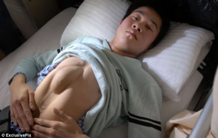Anh Huang Rongming, ở tỉnh Hà Nam (Trung Quốc), người đã trải qua ca phẫu thuật đưa tim vào lồng ngực.