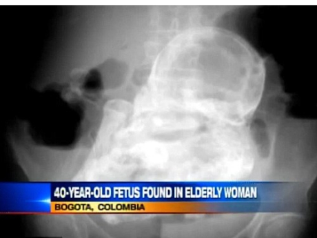 Bào thai vôi hóa 40 năm được tìm thấy trong bụng cụ bà. 