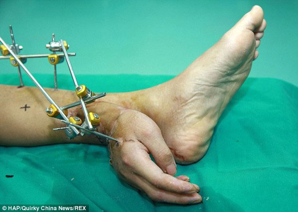 Bàn tay được ghép ở mắt cá chân của anh Wei để chờ phẫu thuật.