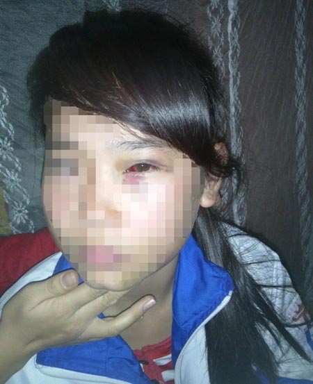 Nữ sinh H. bị Cấn So Ny đánh bầm tím mặt mũi