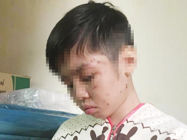 Bé trai bị đánh rạn xương sườn: Mẹ kế khai lý do hành hạ con chồng