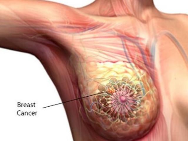 Đã là phụ nữ, bạn đừng quên 7 dấu hiệu ung thư vú