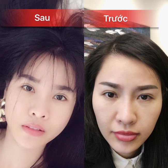 tinh cu truong giang, thu thuy, ha lade: nu hoang phau thuat tham my 2018 hinh anh 1