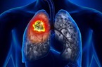 Hệ thống trí tuệ nhân tạo giúp phát hiện sớm ung thư phổi