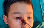 Nghệ An: Cấp cứu bé trai với chi chít mũi tên ghim vào mặt