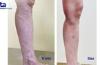 Bệnh viện Tâm Anh điều trị hiệu quả suy giãn tĩnh mạch chân cho bệnh nhân bằng phương pháp Laser nội mạch