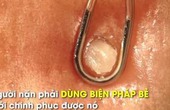 Pha bẻ mụn trứ danh nhân to như hạt gạo