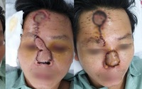 Người đàn ông 42 tuổi có cái mũi đáng sợ sau khi xuất hiện mụn nhỏ
