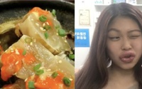 Cô gái bị sưng vều môi vì món cua ngâm tương Hàn Quốc