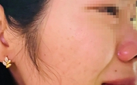 Giáo viên bị phụ huynh đánh bầm dập, hiệu trưởng nói "không liên quan"