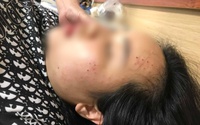 Cô gái sốc vì bị tiêm nhầm sữa rửa mặt vào da khi đi làm đẹp tại spa