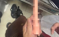 Nam sinh bị "mắc kẹt" khi dùng đồ chơi tình dục dài 30cm