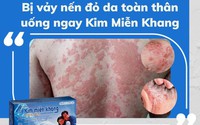 Bệnh vảy nến đỏ da toàn thân và giải pháp điều hòa miễn dịch từ Kim Miễn Khang