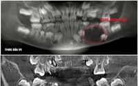 Bé 9 tuổi suýt mất nhiều răng vì nang xương hàm lớn