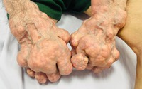 Sửng sốt với đôi tay biến dạng, u cục lồi lõm do gout nặng