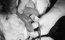 Bệnh nhân Covid-19 thủng ruột sau khi uống thuốc nguyên vỏ