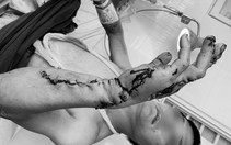 Phẫu thuật khẩn trong đêm cứu cánh tay bị máy cưa nghiền nát