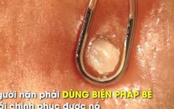 Pha bẻ mụn trứ danh nhân to như hạt gạo