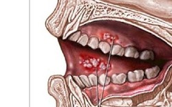 Bị ung thư vì thứ triệu người mê