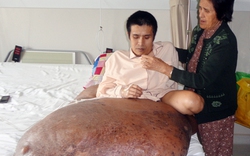 Phẫu thuật cho bệnh nhân có khối u 90kg