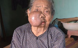 Cụ bà 86 tuổi gần một thập kỷ vác khối u khổng lồ trên mặt