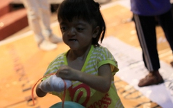 Cô gái bị dính liền các ngón tay, chân và hàng loạt căn bệnh hiểm nghèo