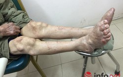  Suy thận vì điều trị gout ở phòng khám đông y Trung Quốc