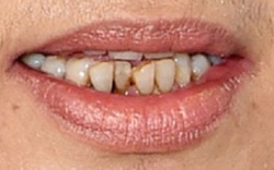 Răng hỏng gây hại đến cơ thể như thế nào? 