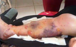 Đăk Lắk: Thiếu nữ phải cưa chân vì bác sĩ tắc trách