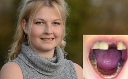 Thiếu nữ bị bệnh lạ hễ hắt hơi là rụng răng