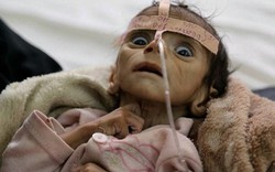 Bé 5 tháng tuổi sinh ra trong chiến tranh, đói đến chết