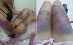 Hà Nội: Cô gái trẻ tố bị bạn trai hành hung dã man