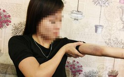 Thanh niên bị “tố” đánh bạn gái tím tay chân từng liên quan án giết người