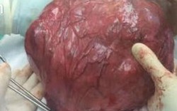 Thừa Thiên - Huế: Lấy khối u nặng 5 kg trong cơ thể nữ bệnh nhân