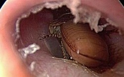 Tự xịt thuốc diệt côn trùng vào lỗ tai để giết gián