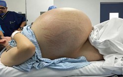 Sốc: Cô gái có khối u nang to nhất thế giới, nặng 32 kg
