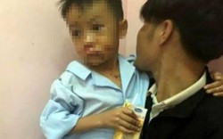 Nghịch đồ lạ, 2 anh em bị dập nát tay, chấn thương mặt