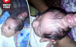 Philippines: Bé trai “mọc sừng” trên đầu khiến bác sĩ sửng sốt