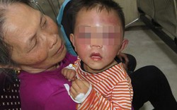 Bé trai 2 tuổi bị bố dượng đánh bầm tím mặt