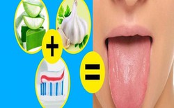 10 cách chữa bệnh lưỡi trắng đơn giản nhất ngay tại nhà