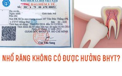 Nhổ răng khôn có được hưởng BHYT không?