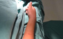 Chữa gãy tay bằng thuốc nam, bé trai 11 tuổi biến dạng cổ tay