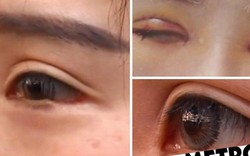Một phụ nữ phẫu thuật cho mắt to ra không ngờ bị cắt mất mí mắt