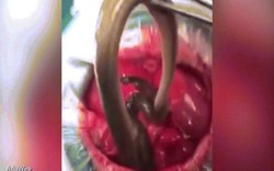 Video: Gắp lươn dài 50cm trong ổ bụng bệnh nhân ở Trung Quốc
