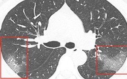 Nóng: Công bố ảnh chụp lá phổi bị virus corona tàn phá